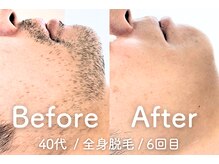 ユング 渋谷店(YUNG)/【ヒゲ脱毛】頑固な青ヒゲ解消◎