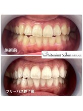 ホワイトニングサロン 京都烏丸店/ホワイトニング施術例　