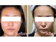 小顔矯正サロン ブルーム/施術1回のビフォーアフター