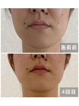 アクアンジュ(Aquange)/ほうれい線と毛穴が線が消えた！