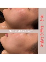 ミニョ コリアンビューティー(Minyoo korean beauty)/症例写真/赤み、肌荒れ