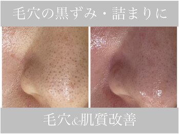 アリスビューティー(AliceBeauty)/毛穴のお悩みに