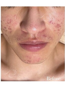 リベル 名古屋(Lebelle:)/ハーブピーリング専門名古屋