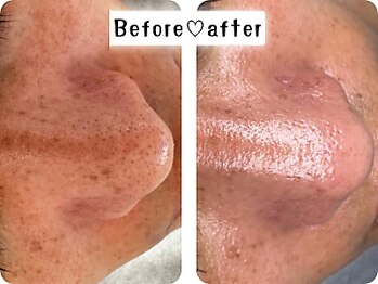 エムエー(MA)/水光ピール（部分毛穴ケア）