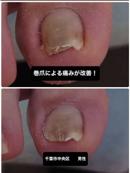 巻き爪の痛み改善するなら当院へ