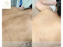 サロンドレナ 名駅店/ハーブピーリング サロンドレナ