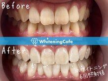 歯のホワイトニングWhiteningCafe六本木店【ホワイトニングカフェ】/ホワイトニングビフォーアフター