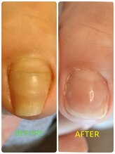 フットスタジオ アルク(FOOT STUDIO ALUK)/【陥入爪】のケア