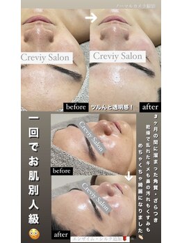 クレヴィー(Creviy)/陶肌トリートメント×エンザイム