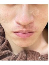 リベル 名古屋(Lebelle:)/ハーブピーリング専門名古屋