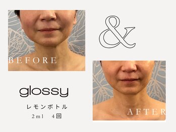グロッシー(glossy)/【症例】レモンボトル小顔60代