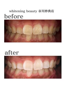 ホワイトニングビューティー 市川妙典店/歯科提携/ホワイトニング/妙典