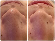 イデアルミー 大宮店(イデアルMe)/毛穴洗浄1回目Before After