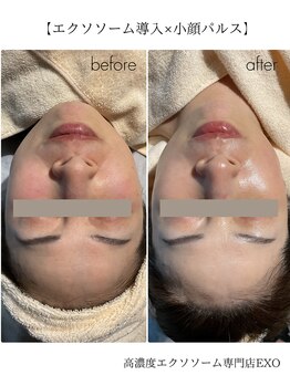 エクソ 吉祥寺(EXO)/エクソソーム×パルスの結果写真