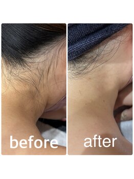 クラスペディア 嘉島店/うなじビフォー・アフター