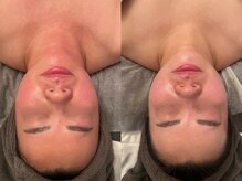 ポーデベロア(Peau des velours)/背中エステ/陶肌トリートメント