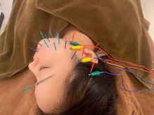 松戸駅前鍼灸院 整骨院の雰囲気（美容鍼でお顔すっきり【たるみ改善/むくみ改善/リフトアップ】）