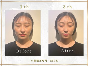 シルク(SILK)の写真/【女性の顔の悩みに特化した小顔矯正】結果重視のあなたは、小顔矯正SILKへ。