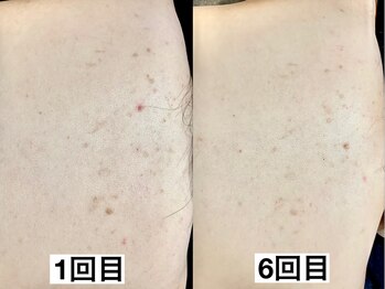 エモーショナル 姫路(Emotional)/剥離しないハーブピーリング◎