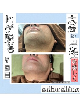 サロンシャイン(Salon Shine)/ヒゲ脱毛経過５０代男性