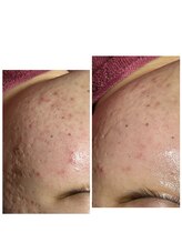 ビマリア(美-MARIA)/ハーブピーリング１回