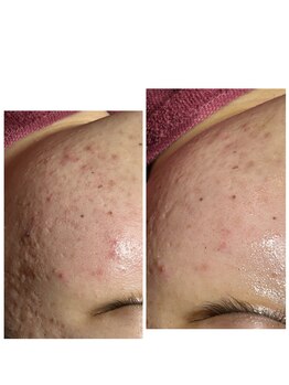 ビマリア(美-MARIA)/ハーブピーリング１回