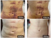 インディラグゼ 麻布十番/術後1週間からケアスタート！