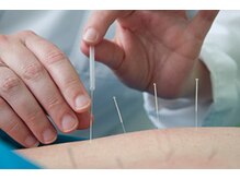 みてら鍼灸整骨院/鍼施術風景