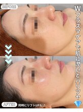 ベルファーム(Belle Femme)/プラズマリフトで小顔ケア