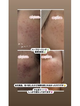 ル メルシェ(Lemerci)/ハーブピーリングで根本から！！