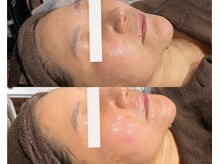 フェイスプラスリフ(FACE+RiF)/たるみケア、艶肌改善