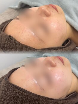 プラシア 広島駅(Purasia.)/毛穴完了 毛穴洗浄