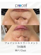 ユミト(Umit)/プロセルフェイシャル
