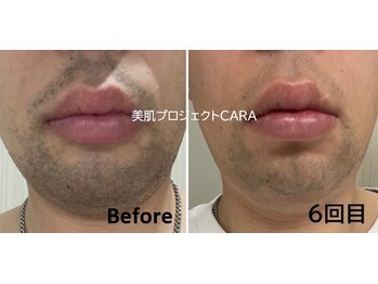 美肌プロジェクト カーラ 東川口店(CARA)/【メンズ脱毛】爆抜ひげ脱毛