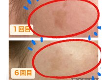 パルティノ 高崎店/シミケアで緩和