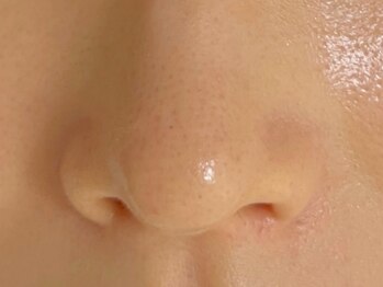 ミベル(MeBell)の写真/【韓国で話題★】ララピール進化版のセラピール導入！お肌悩みを改善し陶器美肌に♪痛みが苦手な方にも◎