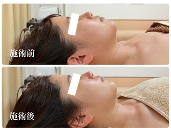 キーオブフェイス(Key of Face)/お悩み【2重顎とほうれい線】