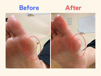 ピース/足のタコにお悩みの60代女性