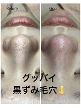 リンカ(Rinca)/毛穴改善します！