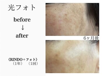 アルゴ 吹田千里山駅前店(ALGO)/光フォト+RINDOスキンケア