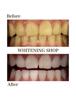 ホワイトニングショップ 府中店/ビフォーアフター