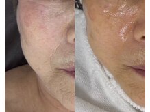 シェリートーキョー 成田店(Cherie Tokyo)/セルマン/韓国式肌管理/成田店