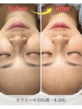 シャムリー(SHAMRY)/セラピール