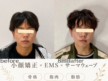 エスポワール(espoir)/メンズ小顔=頬下がスッキリ