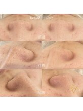 ラヴィス(RAVIS)/1回の施術で黒ずみ撃退！！！