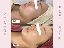 ルア(LuA.)/ホームケアで肌荒れ改善◎