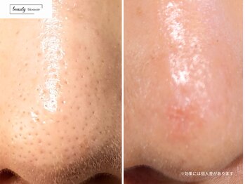 ビューティー ブロッサム(Beauty Blossom)/