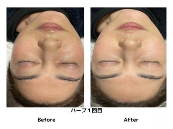 レティティア(Laetitia)/症例4【白玉ハーブピーリング】