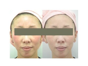 アブソリュートワン(absolute1)の写真/速攻美白!強烈なUVダメージによるシミくすみ毛穴トラブルを奇跡の幹細胞磁気パックで復元!首までケア◎