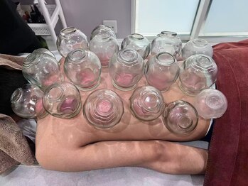 楽美/カッピング施術風景